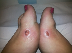 Yummy diving blisters